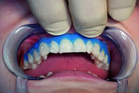 dental bleaching clinic in mumbai