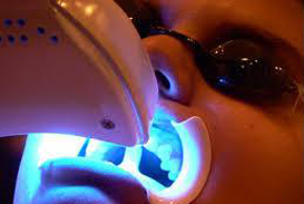 dental bleaching clinic in mumbai