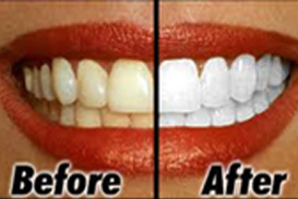 dental bleaching clinic in mumbai