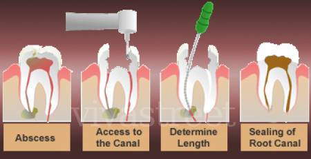 Root Canal Treatment in Mumbai Root Canal Treatment in Mumbai