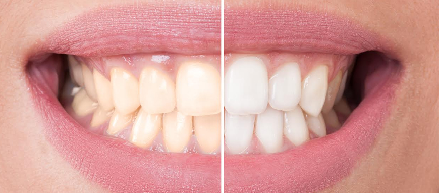 Dental Bleaching Clinic in Mumbai