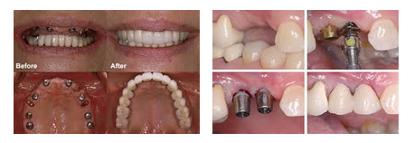 Dental Implant Service in Mumbai