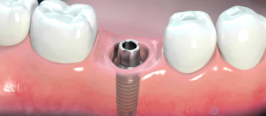 Dental Implant Service in Mumbai