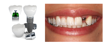 Dental Implant Service from India
