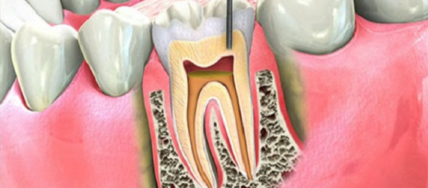 Root Canal Treatment Dentist in Mumbai